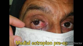 Ectropion  Medial Ectropion  Conjunctivoplasty  Ectropion Correction [upl. by Pat]