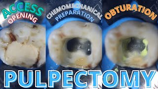 Access Opening 🟡 Chemomechanical Preparation 🟣 Obturation ⚪️ Pulpectomy [upl. by Ahtenek547]