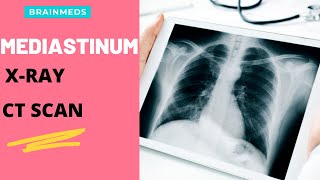 How to interpret Mediastinum RADIOLOGY LEARN EASILY XRAY AND CT SCANS Covid 19 patients [upl. by Eloisa]