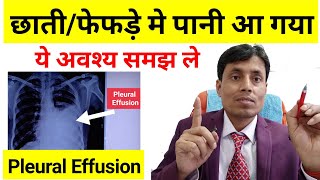 PleuralEffusion in Hindi  chhati me pani bhar jana  Pleural effusion Treatment by Dr Sanjay kr [upl. by Revlys]