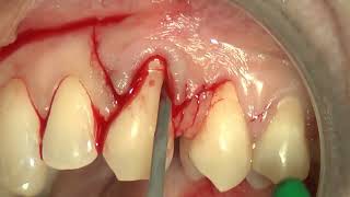 9 Multiple bilaminar technique with single vertical releasing incision in the upper jaw [upl. by Noswad274]