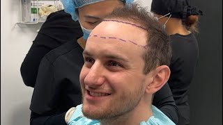 How to decide Hair transplant hairline height [upl. by Cohl195]