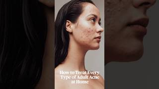 Teenage age mein kyu pimples kyu hote hai  pimple reasonofpimples acne shortvideo [upl. by Georgena165]