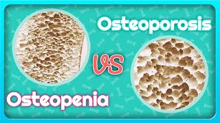 Osteoporosis vs Osteopenia Whats the Difference [upl. by Araldo]