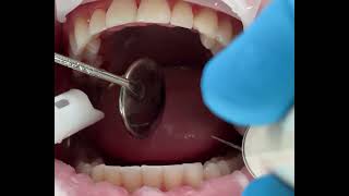 ASMR  Dental scaling [upl. by Enyalb]