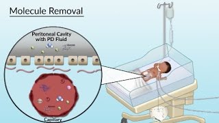 Peritoneal Dialysis by S Su A Olszewski  OPENPediatrics [upl. by Agiaf95]