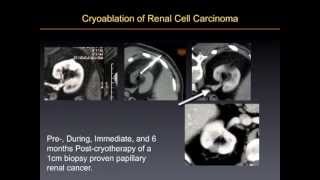 UCSF Radiology Radiological Imaging and Cryotherapy for Cancer Treatment [upl. by Wilser]