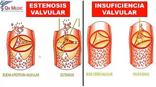 Valvulopatías de hemicardio izquierdo [upl. by Fredela]