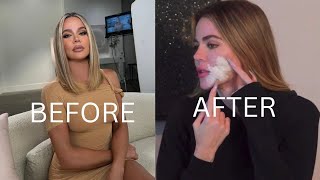 Khloé Kardashian Shares Her Skin Cancer Battle and Cheek Filler Results [upl. by Marylin716]