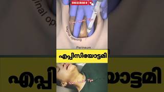 പ്രസവസമയത്ത് episiotomy ചെയ്യുന്നത്pregnancy education malayalam [upl. by Som162]