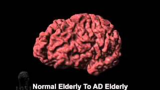 Cortical Atrophy Associated with Alzheimers Disease [upl. by Zizaludba342]