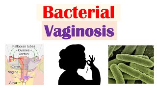 Bacterial Vaginosis Vaginal Infection Causes Risk Factors Symptoms Diagnosis Treatment [upl. by Powder]