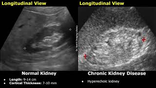 Kidney Ultrasound Normal Vs Chronic Kidney Disease CKD Imaging Findings  Chronic Renal Failure [upl. by Hedwig]