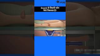 ESWL  Lithotripsy  Kidney Stone Treatment  Rirs shorts [upl. by Ahsiryt881]