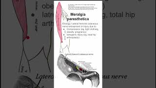 Meralgia paresthetica [upl. by Britni]