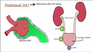 Acute Kidney Injury AKI  PrerenalIntrarenalPostrenal [upl. by Farant]