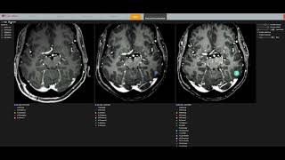 NeuralRad Brain Tumor Tracking Demo [upl. by Dub]