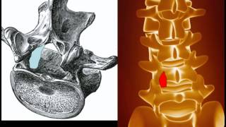 Behandlung der Spinalkanalstenose [upl. by Dazhahs]