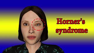 Horners syndrome  Symptoms and causes [upl. by Oiuqise]