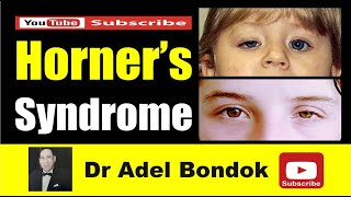 Horners Syndrome Dr Adel Bondok Making Anatomy Easy [upl. by Sokram]