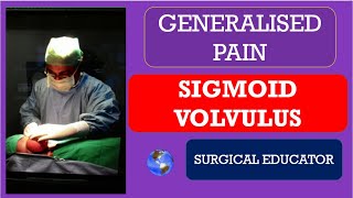 SIGMOID VOLVULUS How To DIAGNOSE amp TREAT Generalised Abdominal Pain [upl. by Benjy981]