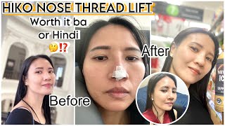 HIKO NOSE THREAD LIFT [upl. by Nivre986]