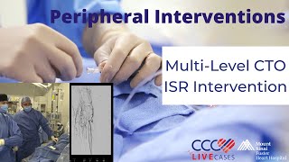 MultiLevel CTO ISR Intervention [upl. by Yrruc167]