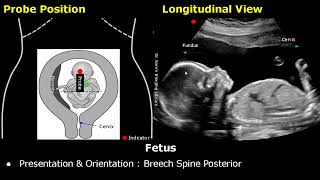 Obstetric Ultrasound Probe Positioning  Pregnant Uterus amp Fetus Transducer Placement USG Scan [upl. by Eiznik63]