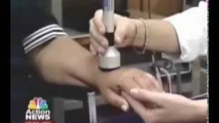 Alternative Carpal Tunnel Treatment National News report on Microlight ML830® Cold Laser Therapy [upl. by Studley697]