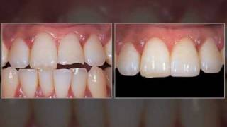 Veneers  Chipped Tooth [upl. by Milka]