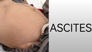 Ascites II Grades of Ascites II Treatment of Ascites II DrKhalil [upl. by Sille]