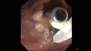 Ampullectomy of a papillary adenoma [upl. by Chrysa]