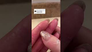 Do I have fingerprints Epidermolytic Palmoplantar Keratoderma  Jan 20 2023 [upl. by Dlanger]