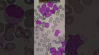 Así se ve la LEUCEMIA aguda al microscopio hematología leucemia laboratorioclinico [upl. by Niu]