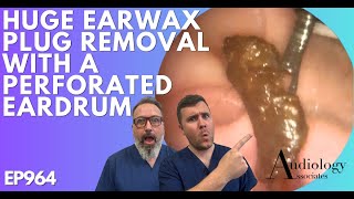 HUGE EAR WAX PLUG REMOVAL WITH A PERFORATED EARDRUM  EP964 [upl. by Jaela119]