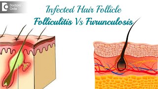 Infected hair follicle What to do Causes Location amp TreatmentDr Rasya Dixit  Doctors Circle [upl. by Westbrook585]