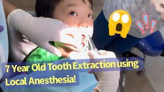 7 Year Old Baby Tooth Extraction With Local Anesthesia 1st Adult Tooth  Kids Dental  Kids Dentist [upl. by Laeno849]