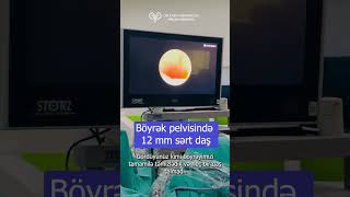 Böyrək daşı əməliyyatı Retrograde İntrarenal Surgery RİRS uroloq androloq [upl. by Celestina]