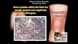 Elbow amp Knee Bursitis Caused By Gout  Everything You Need To Know  Dr Nabil Ebraheim [upl. by Gamaliel]