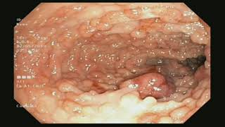 Familial Adenomatous Polyposis Coli FAP found during Colonoscopy [upl. by Anahgem]