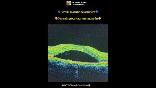 Serous macular detachment Central serous chorioretinopathy [upl. by Thurstan]