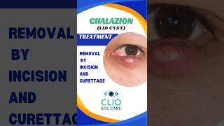 Chalazion Treatment Incision and Curettage  CLIO Eye Care [upl. by Eilahs]