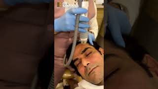 A look at the Vivace RF Microneedling Treatment  Face [upl. by Fiora206]