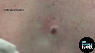 8 MINUTES OF SATISFYING POPS with Dr Sandra Lee  Dr Pimple Popper [upl. by Lanor]