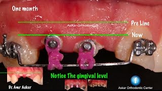 Orthodontic extrusion for remaining roots to get ferrule effect for bridge  ortho course [upl. by Levin]