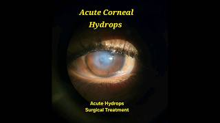 Acute Corneal Hydrops Surgical Draining [upl. by Llednik]