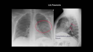 Chest Xray Cases 1 [upl. by Llerrac148]