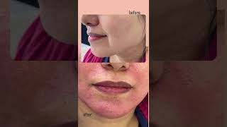 Eliminate Marionette Lines and Smile Lines with Full Face Filler Injection by Dr Sanaz Amiri [upl. by Keung]