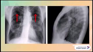 sindrome obstructivo pulmonar [upl. by Burroughs]