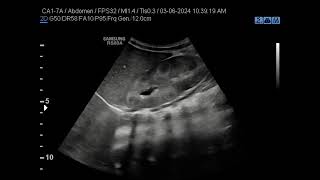 Medullary Nephrocalcinosis [upl. by Christabel926]